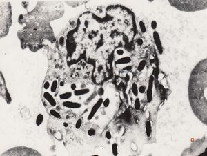 F,43y. | phagocytosed microbes - bacteriaemia F,43y. | phagocytosed microbes - bacteriaemia